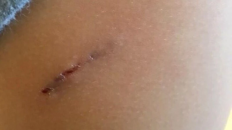 В Южно-Сахалинске царапина на теле воспитанника детсада привела к расследованию