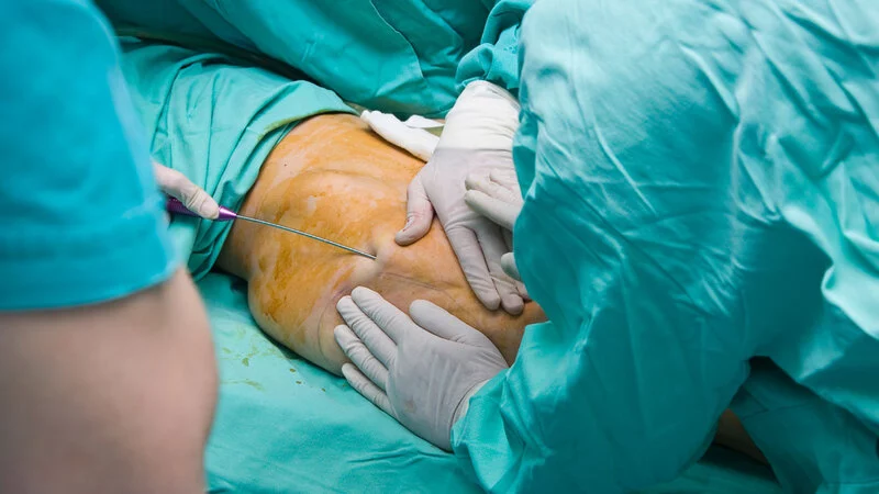 Липосакция: за и против