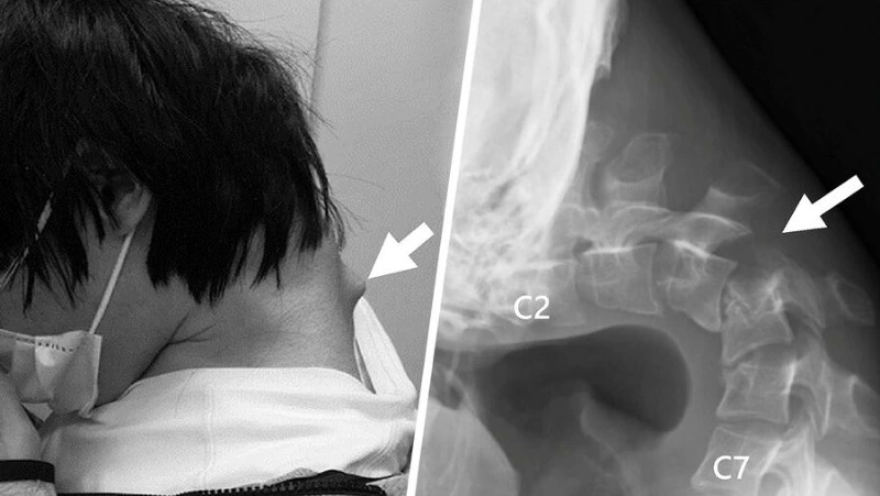 У молодого японца из-за интенсивного использования смартфона развился синдром опущенной головы