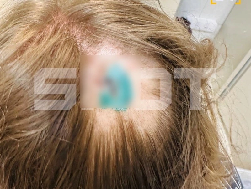 Туристка получила сотрясение мозга после встречи со злой чайкой на Сахалине