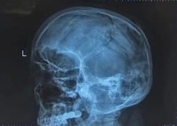 Хирургам удалось восстановить череп жителя Приморья после удара топором