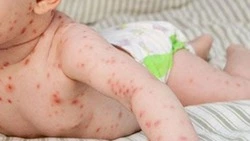Врач назвала жителям Сахалина опасные последствия ветрянки