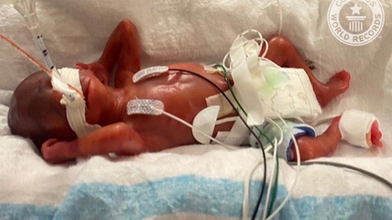 «Мальчик, который выжил»: в Америке родился необычный малыш