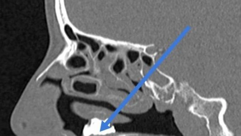 Жительница Подмосковья целый год ходила с кусочками угля в носу 