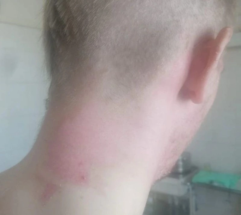 Мужчину с ожогами после взрыва битума выписали из больницы на Сахалине