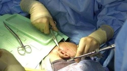 Стало известно о состоянии жителя Сахалина с ожогами 3 степени после взрыва битума