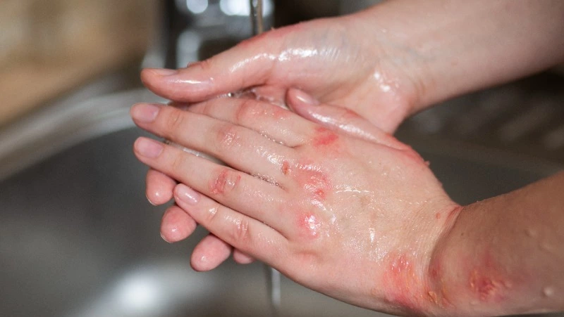 Прокуратура проверит действия УК из-за ожогов у подростков в Южно-Сахалинске