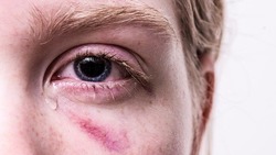 Врачи: чешущийся глаз может быть симптомом рака