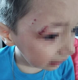 Бездомная собака покусала пятилетнего ребенка на детской площадке в Холмске