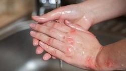 Прокуратура проверит действия УК из-за ожогов у подростков в Южно-Сахалинске