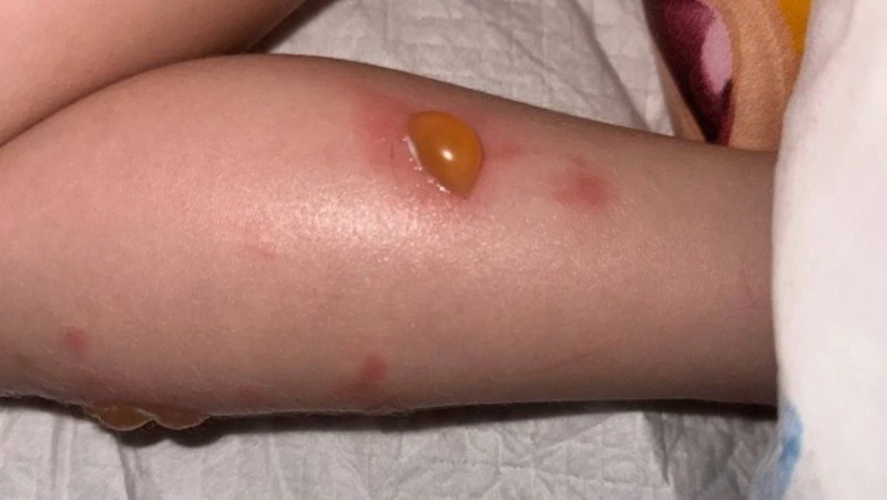 Ожоги второй степени от борщевика получил 2-летний ребенок в Холмске