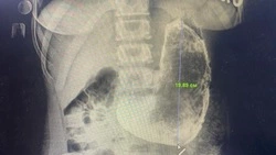 У россиянки нашли огромную опухоль в желудке после приема таблеток для похудения