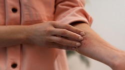 Вынимать самостоятельно или ехать в больницу? Травматолог с Сахалина об укусах клещей и профилактике