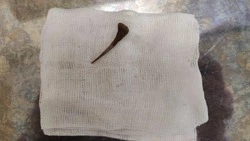 Сахалинка попала в руки хирургов из-за проглоченной куриной кости