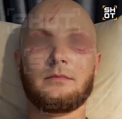 Россиянин едва не потерял зрение после встречи с самой опасной в мире медузой