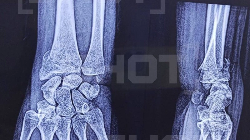 Туристку из России зверски избили во Вьетнаме из-за манеры общения с подругой 