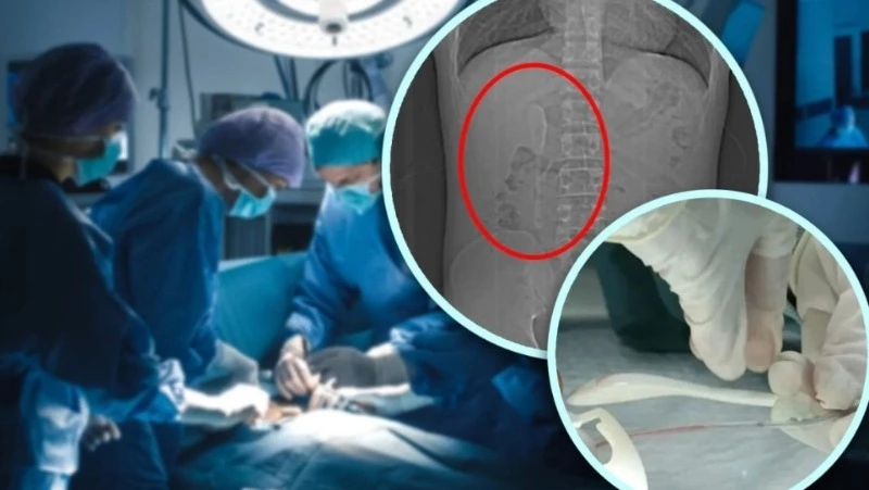 Пьяный житель Китая проглотил ложку и узнал об этом пять месяцев спустя